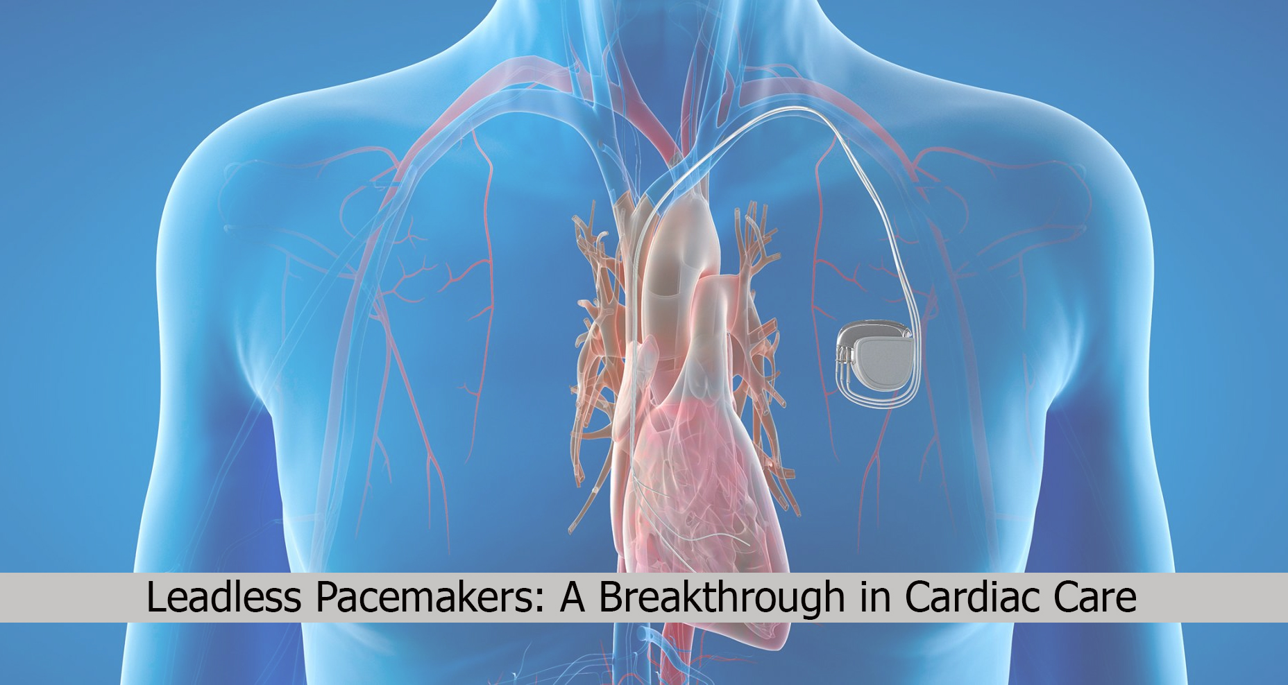 Leadless-Pacemaker.jpg